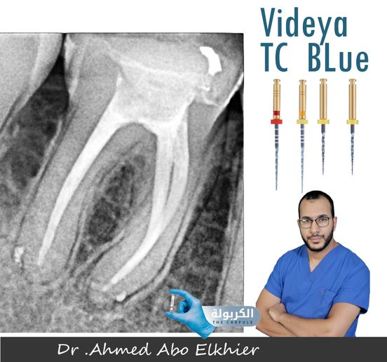 Just anotherEndodontic Treatment for a lower first molar
