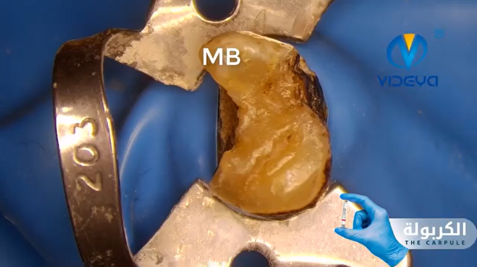 Access Cavity of upper second molar Demo simple and easy 