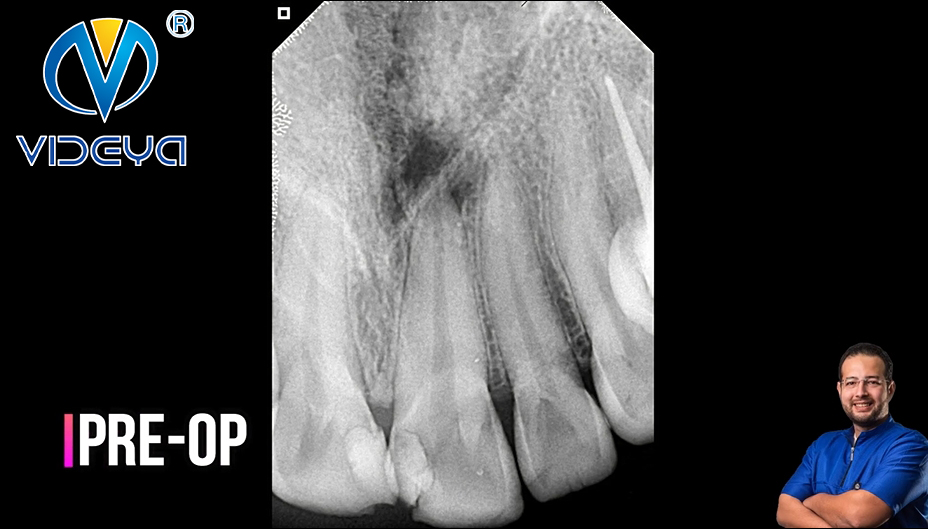 Access Cavity Preparation In Upper Central Incisor 