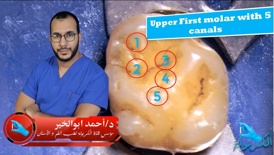 Upper First molar with 5 canals 