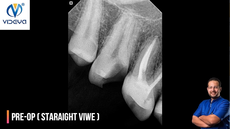 RCT of C-Shaped Upper 1st Molar 