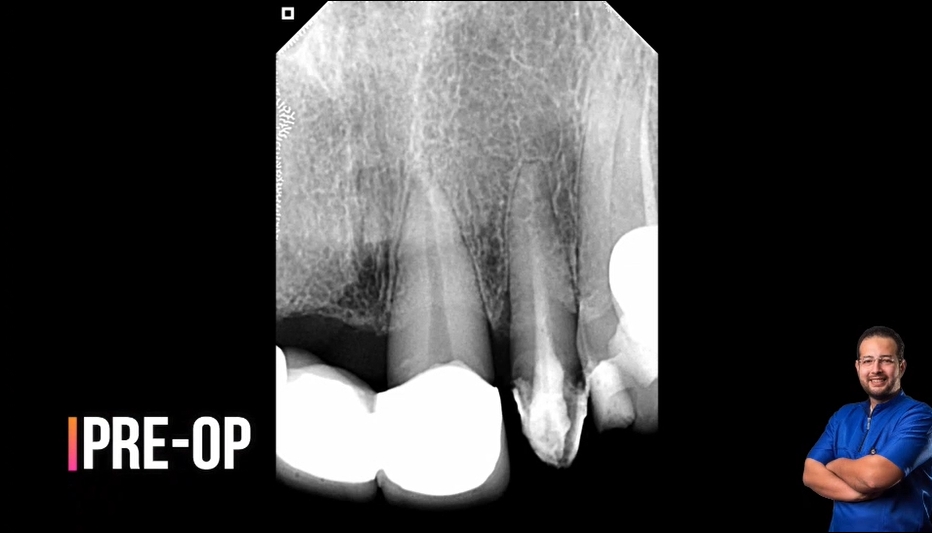 Retreatment of upper Lateral lncisor 