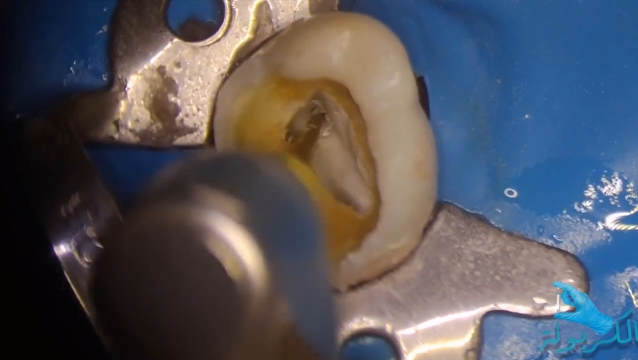 Videya rotary files treatment cases 