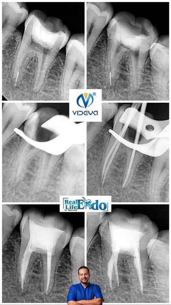 Ultrasonic Broken file Retrieval 