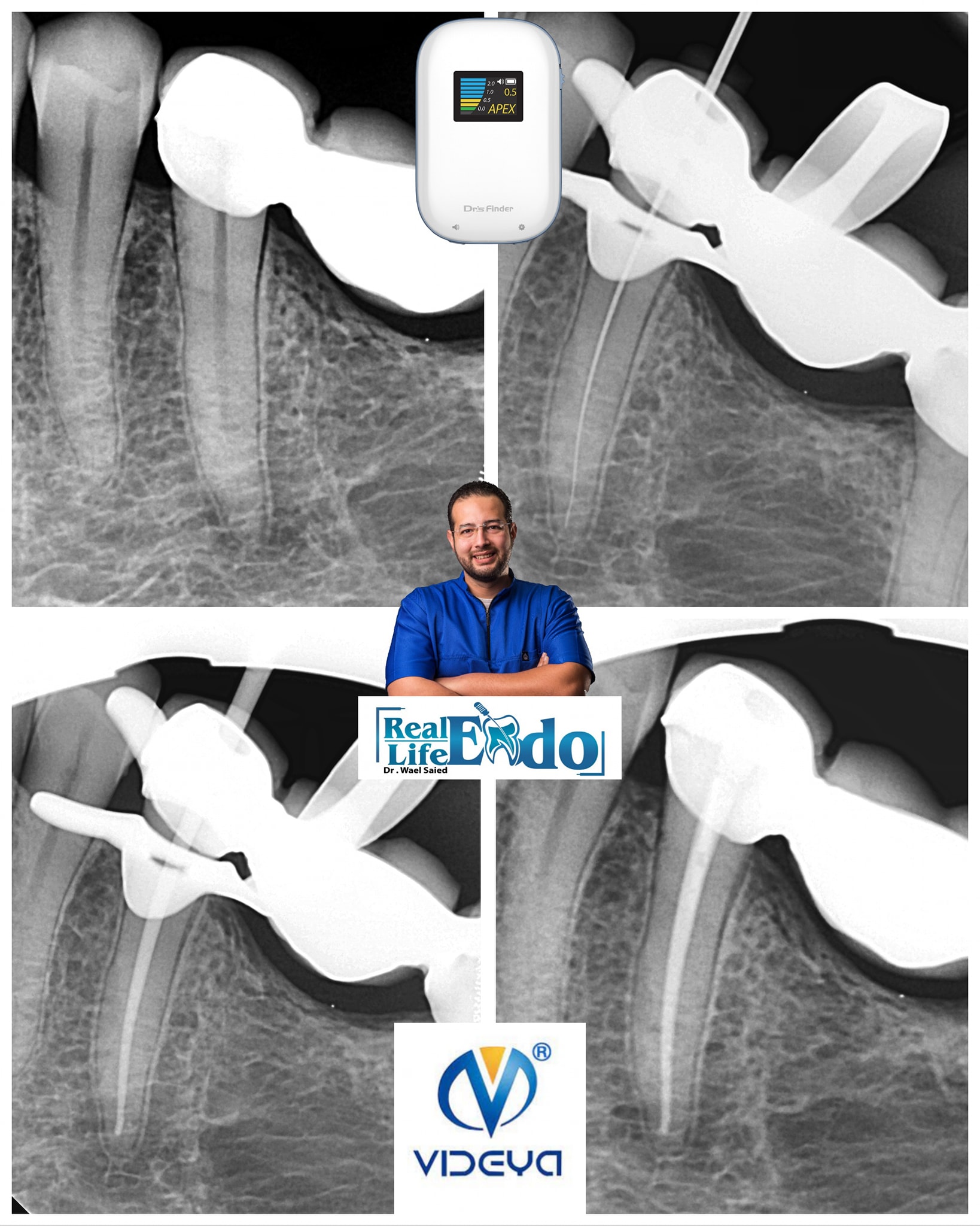Apex Locator function is to determine the location of the Anatomical