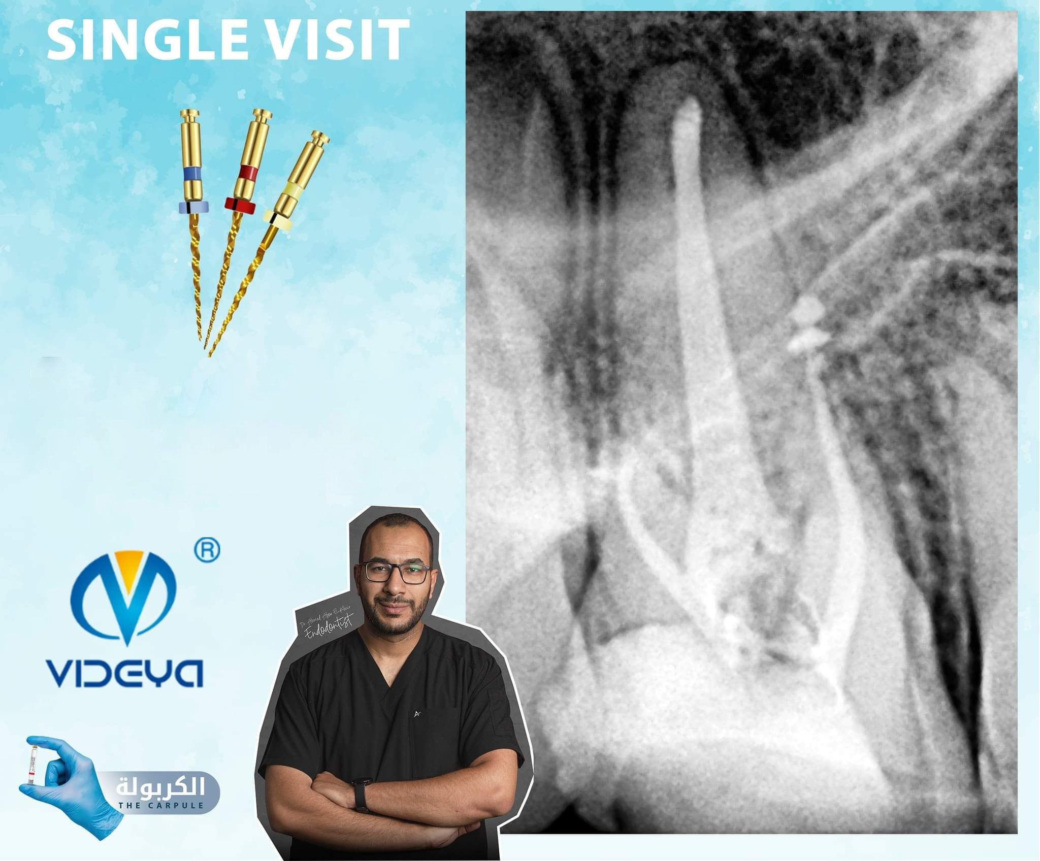 A single Visit Endodontic Treatment