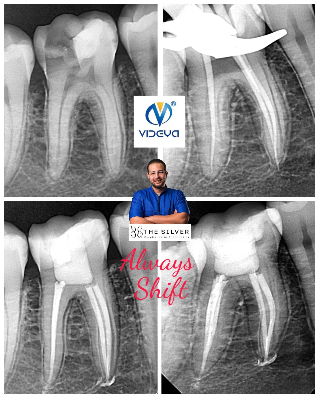 RCT of lower 1st molar 