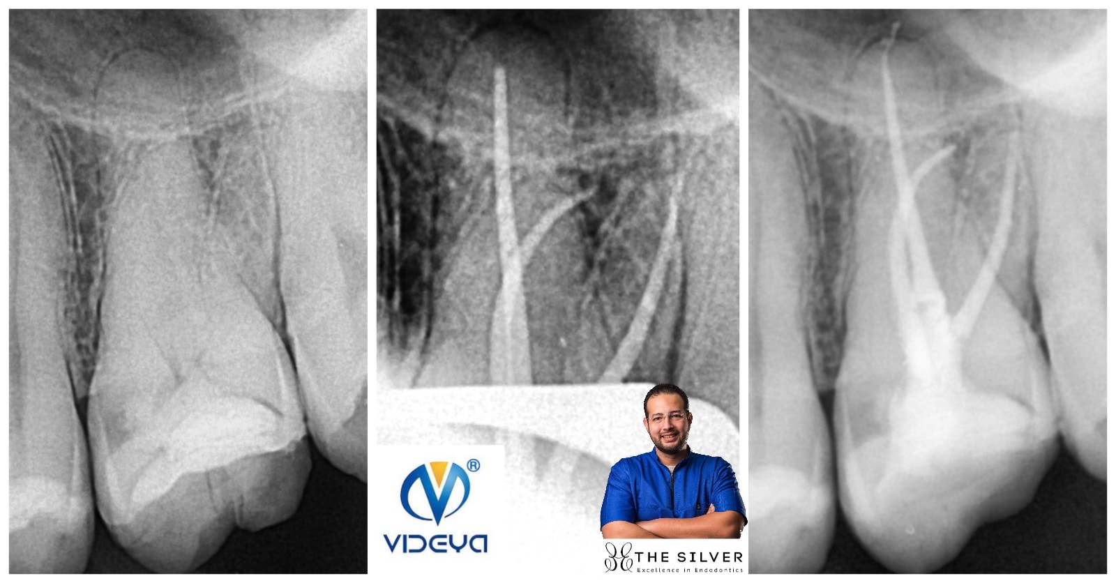 management of curved canals includes 4 main steps 